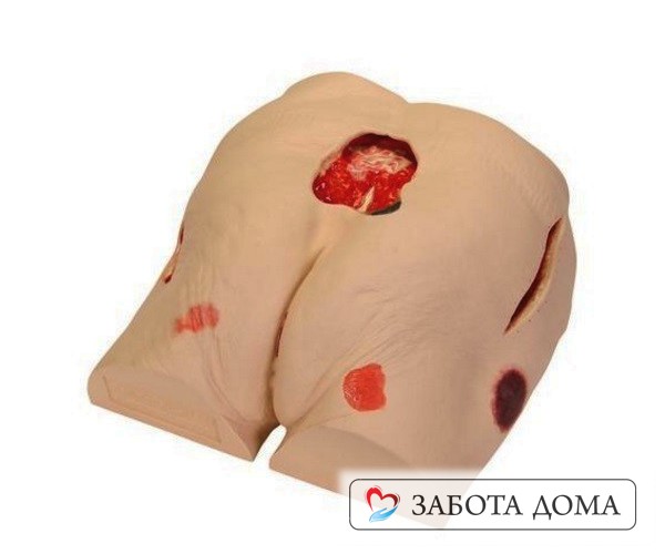 Пролежни на ягодицах возникают часто и сложно поддаются лечению Пролежень на копчике