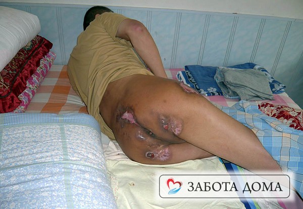 Некротические изменения в области копчика и в области ягодиц являются частым осложнением Пролежень на крестце