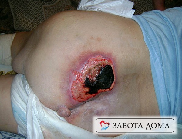 Лечение третьей и четвертой стадии заключается в хирургическом очищении язвы от продуктов некроза. Пролежни на ягодице