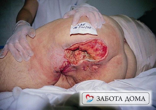 При распространении процесса на мышечную и костную ткани возникает четвертая стадия. Пролежень на ягодицах