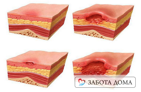 Если давление продолжает действовать, процесс распространяется, область поражения увеличивается и переходит на более глубокие слои — подкожно-жировую клетчатку, мышцы и даже кости. Стадии пролежней