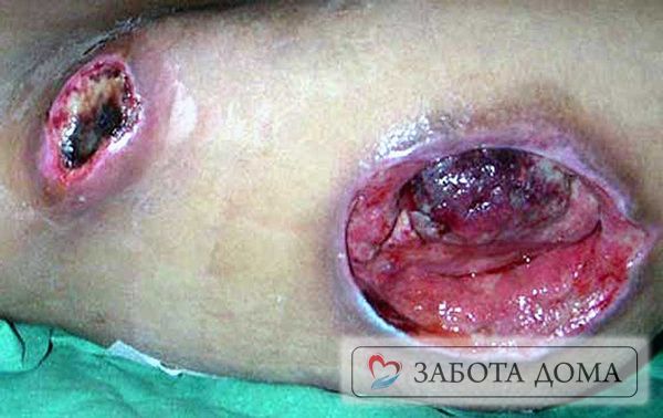 Глуюбокие пролежни Глуюбокие пролежни