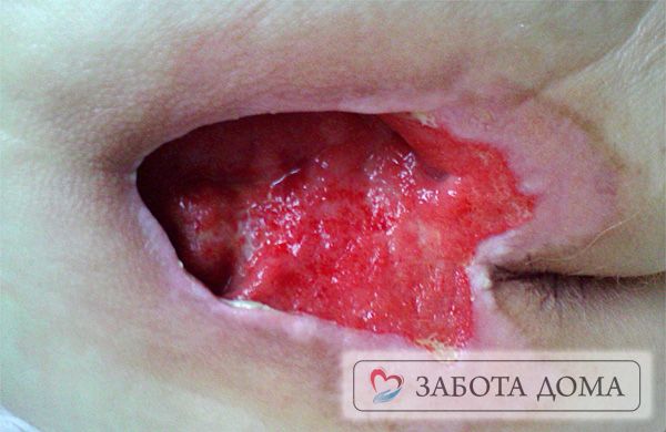 Открытые пролежни у лежачих больных Открытые пролежни у лежачих больных