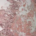 Какие признаки при затяжной пневмонии