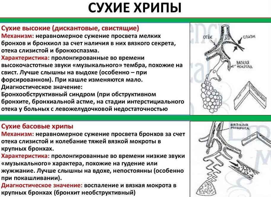 Сухие хрипы