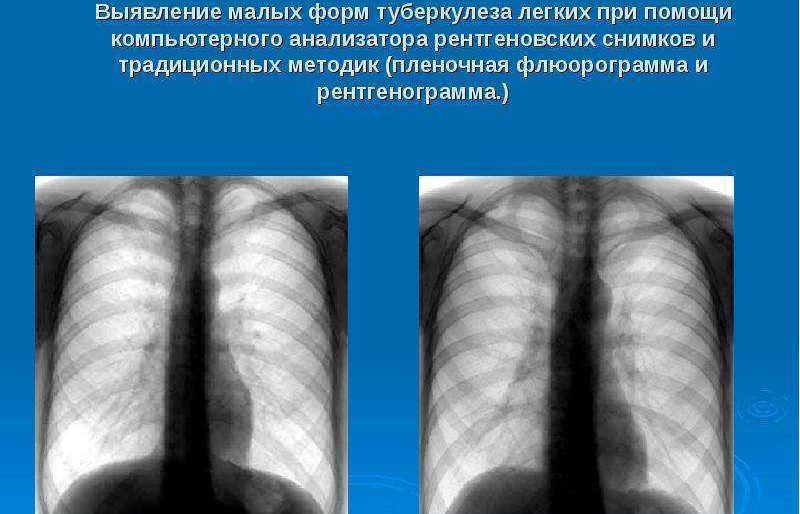Туберкулез на снимке