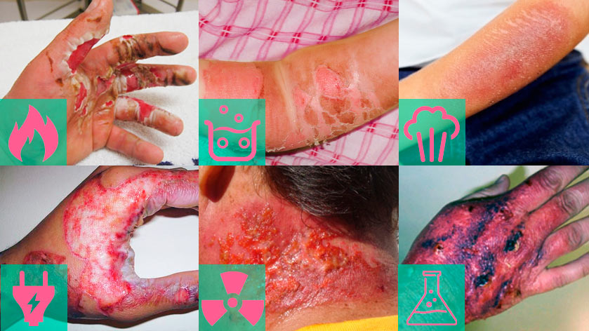 Виды ожогов. Блог Стерильно.com