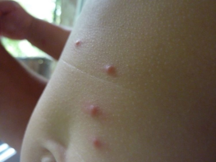 Волдыри на пальцах рук у ребенка похожие на ожог не чешется и не болит