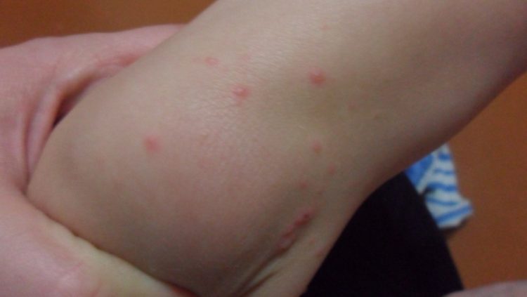 Волдыри на пальцах рук у ребенка похожие на ожог не чешется и не болит