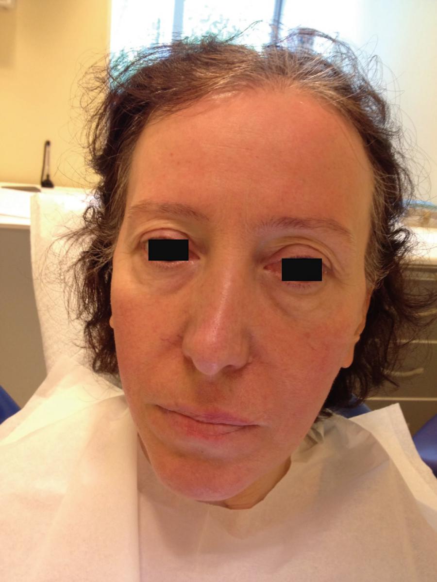 Ожог гипохлоритом натрия в стоматологии