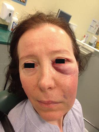 Случайная заапикальная экструзия натрия гипохлорита, диагностированная при помощи томографического исследования