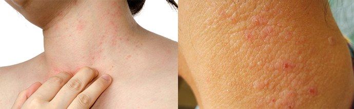 Можно ли получить ожог гепариновой мазью