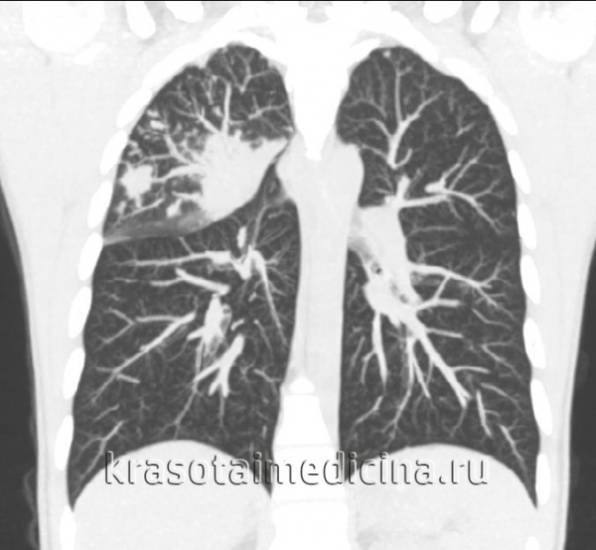 КТ органов грудной клетки. Множественные очаговые изменения верхней доле правого легкого (верифицированный туберкулез) КТ органов грудной клетки. Множественные очаговые изменения верхней доле правого легкого (верифицированный туберкулез)