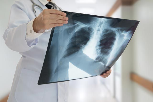 Режим физических нагрузок при пневмонии