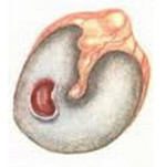 Хронический гнойный средний отит Хронический гнойный средний отит