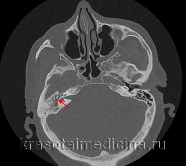 КТ височных костей. Содержимое (гной) в полости среднего уха вокруг слуховых косточек. КТ височных костей. Содержимое (гной) в полости среднего уха вокруг слуховых косточек.