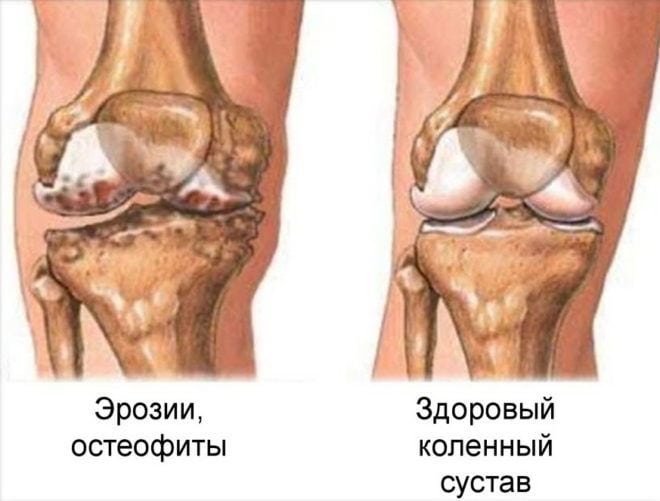 Подагра в коленном суставе лечение