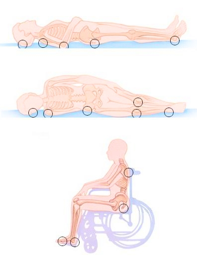 пролежни у лежачих и сидячих.jpg пролежни у лежачих и сидячих.jpg