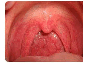 Клебсиелла пневмонии зева, исследуй мазок!