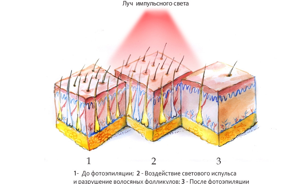 фотоэпиляция схема