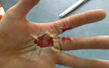 Химический ожог руки