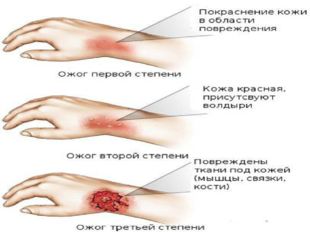 Первая помощь при ожогах обморожениях презентация