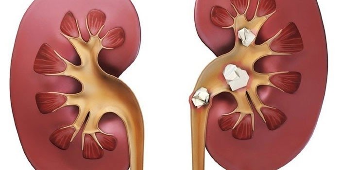 В почках камни