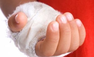 Чем можно лечить ожог волдырь