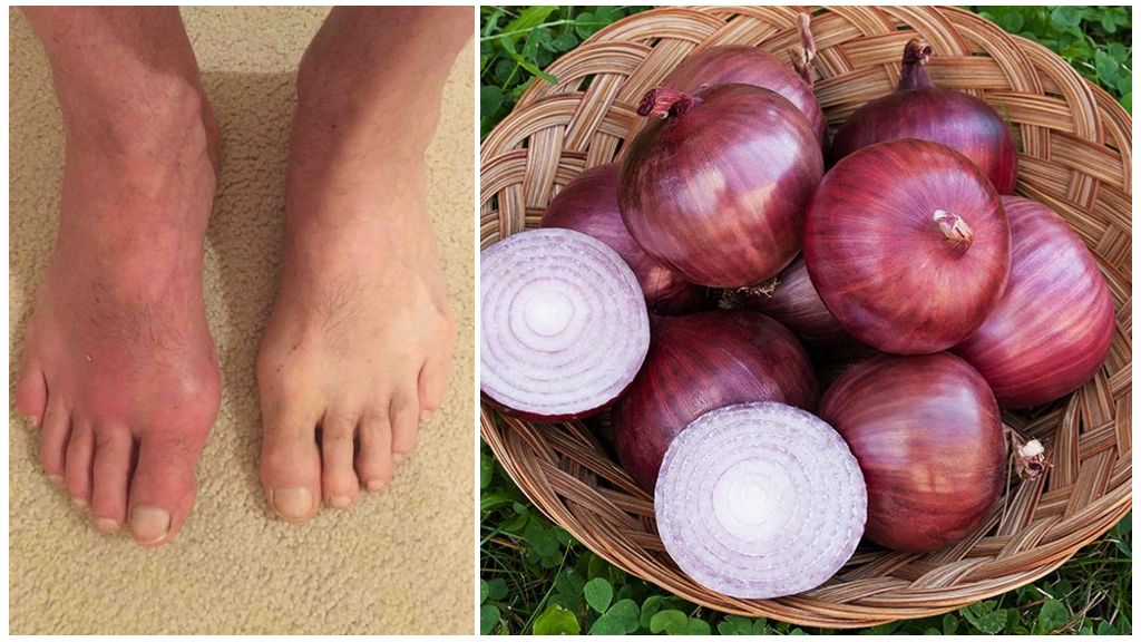 Лук при подагре