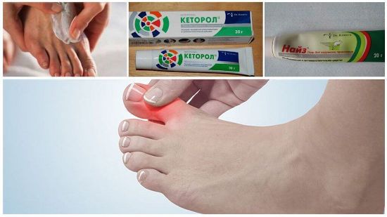 Мази при подагре