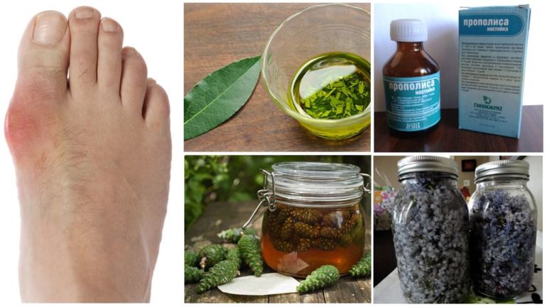 Народные рецепты от подагры