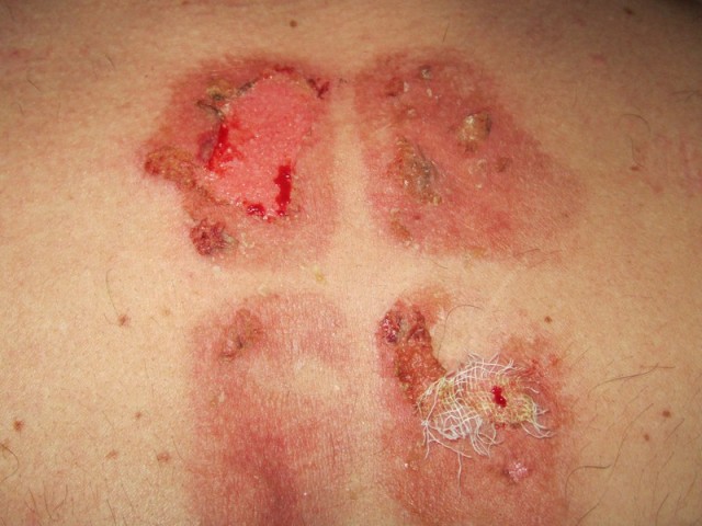 Ожог 3 степени от горчичников на спине