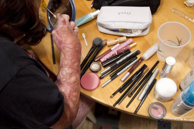 Ожог Ангельского лица (9 фото)