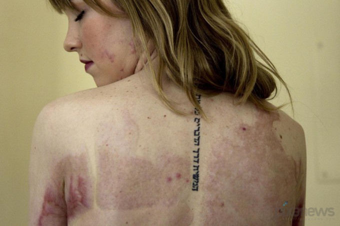 Ожог Ангельского лица (9 фото)