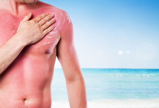 лучевой ожог