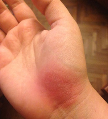 На руке появляется красное пятно, похожее на ожог Как избавится от высыпаний на коже, похожих на ожоги
