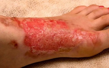 Ожег ступни 3А степени