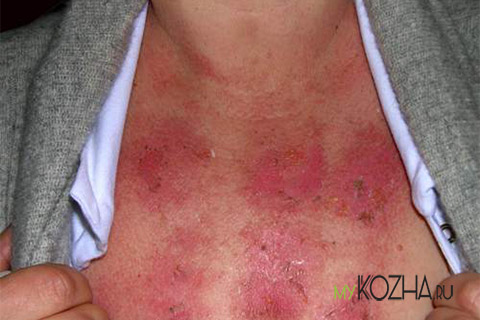 ожог от горчичников