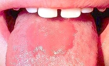 Как лечить ожоги языка, неба и полости рта