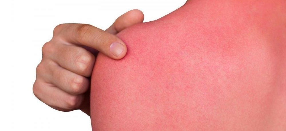 Ожог Ожог после лучевой терапии лечение