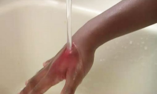 Промывание ожога проточной водой Промывание ожога проточной водой