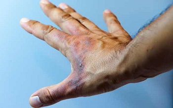 Ожог первой степени на кисти