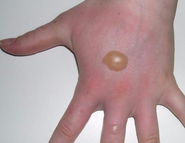 Как быстро убрать волдыри после ожога