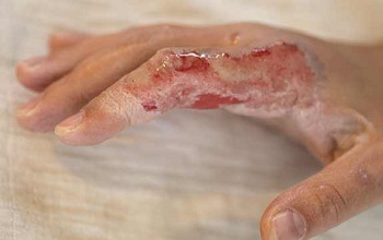 Ожог третьей степени (III А)