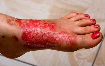 Ожог третьей степени на ступне (III Б)