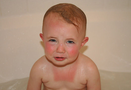 Солнечный ожог у ребенка