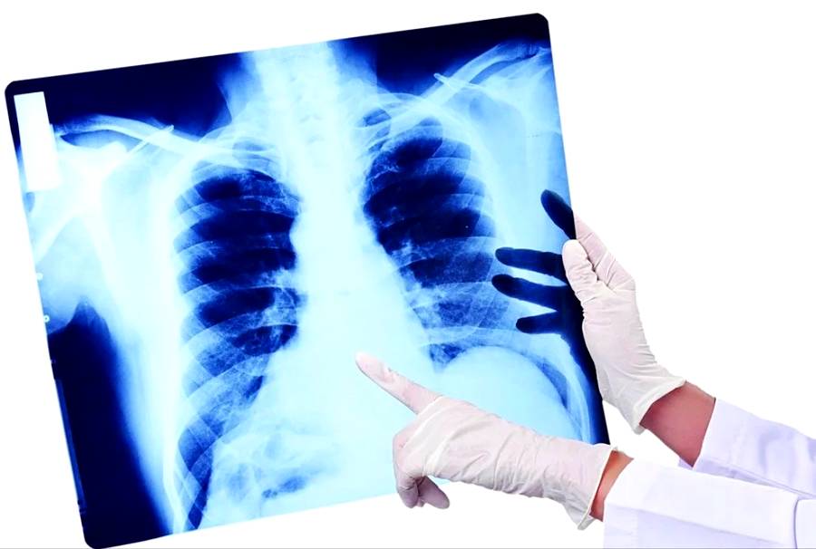 Ходить на ногах при пневмонии