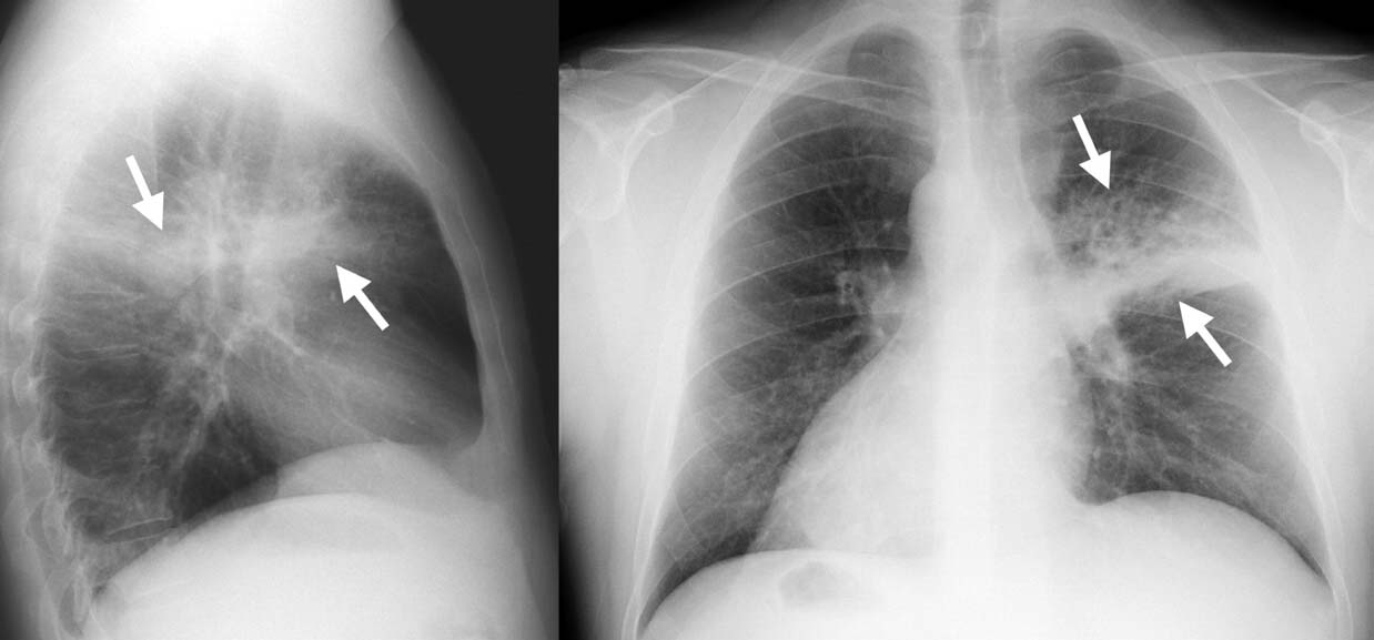 Пневмония на рентгеновском снимке