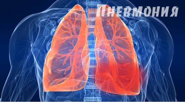 Пневмония - фото. Изображение пневмонии.