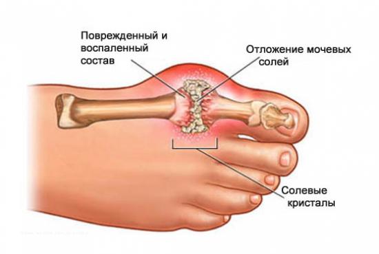 Тофусы при подагре